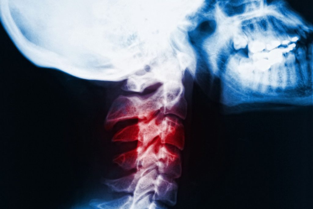 common motorcycle accident injuries