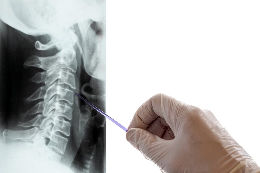 whiplash settlement